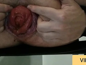5 minutes of prolapse